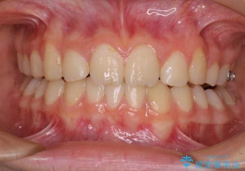 目立つ八重歯を治したい インビザラインによる矯正治療の治療中