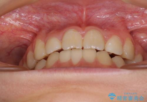 目立つ八重歯を治したい インビザラインによる矯正治療の治療中