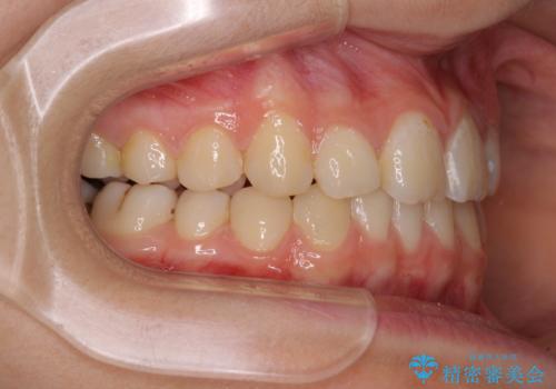 目立つ八重歯を治したい インビザラインによる矯正治療の治療中