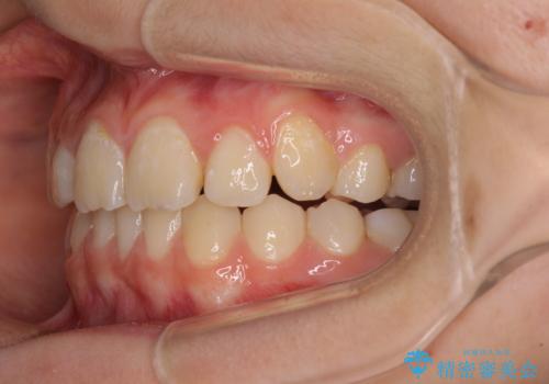 目立つ八重歯を治したい　インビザラインによる矯正治療の治療中