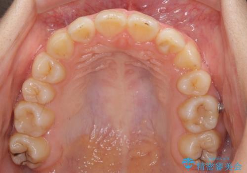 目立つ八重歯を治したい インビザラインによる矯正治療の治療中