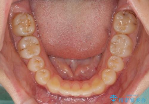 目立つ八重歯を治したい インビザラインによる矯正治療の治療中