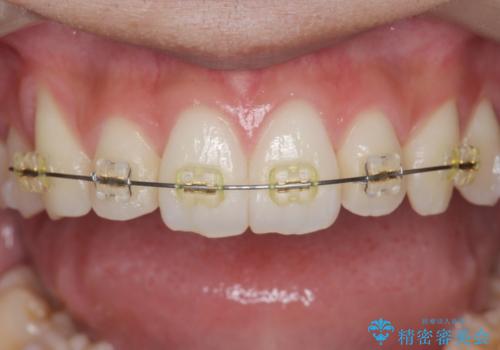[ 下顎3前歯の矯正治療 ]  3インサイザー仕上げのマウスピース矯正の治療後