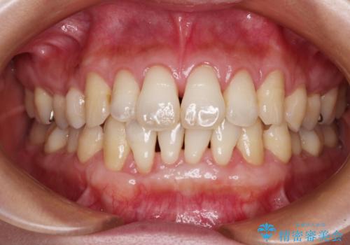 年々下がる歯茎を何とかしたい　歯肉移植術による根面被覆の治療後
