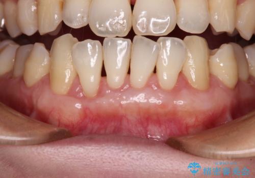 年々下がる歯茎を何とかしたい 歯肉移植術による根面被覆の治療後