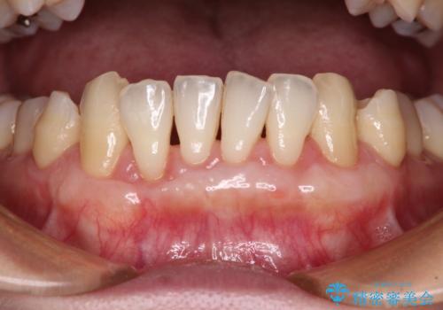 年々下がる歯茎を何とかしたい　歯肉移植術による根面被覆の症例 治療後