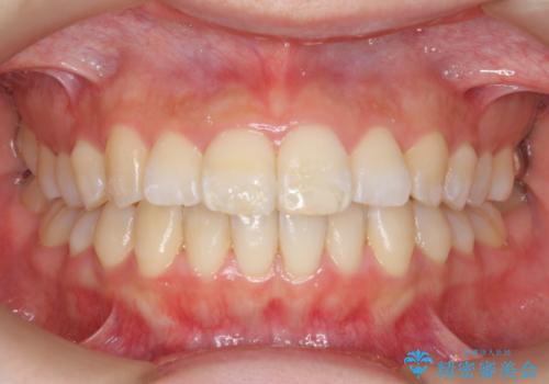 インビザラインで出っ歯の治療の治療中