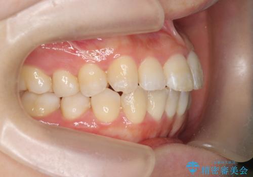 インビザラインで出っ歯の治療の治療中