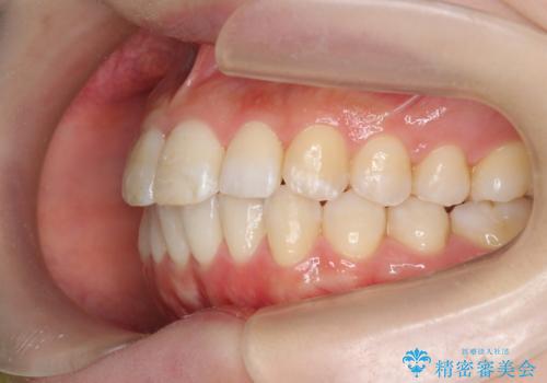 インビザラインで出っ歯の治療の治療中