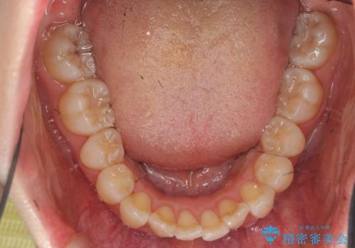 インビザラインで出っ歯の治療の治療中