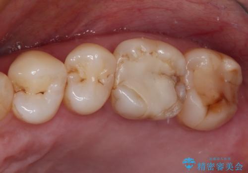 奥歯がしみる　セラミックインレーでの虫歯治療の症例 治療前