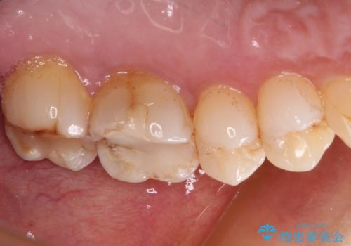 奥歯がしみる セラミックインレーでの虫歯治療の治療前