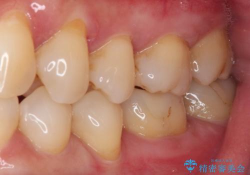 奥歯がしみる セラミックインレーでの虫歯治療の治療前