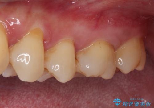 奥歯がしみる セラミックインレーでの虫歯治療の治療前