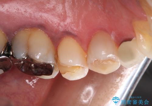 食事の度に痛む 根管治療とオールセラミッククラウンの治療前