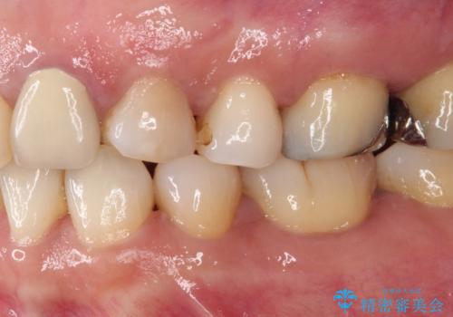 食事の度に痛む 根管治療とオールセラミッククラウンの治療前