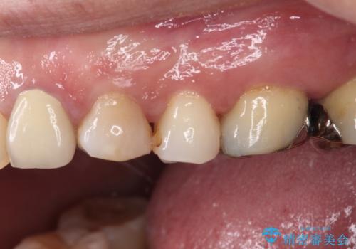 食事の度に痛む 根管治療とオールセラミッククラウンの治療前