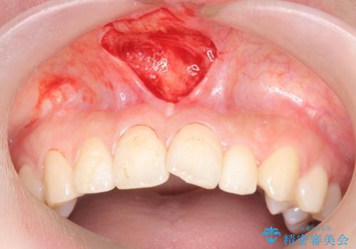 上唇小帯切除の治療中