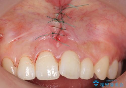 上唇小帯切除の治療中