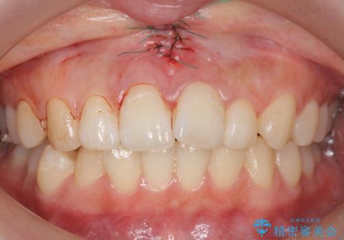 上唇小帯切除の治療中