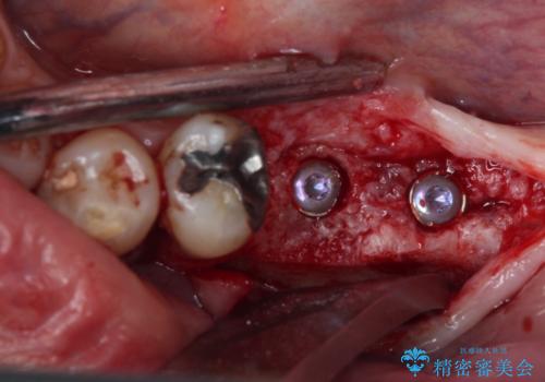 奥歯で噛みたい　インプラントによる欠損補綴治療の治療中