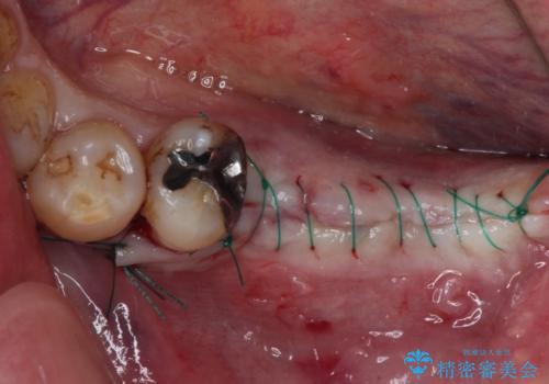 奥歯で噛みたい　インプラントによる欠損補綴治療の治療後