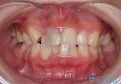 虫歯と抜いたままの奥歯とデコボコの前歯　総合歯科治療の症例 治療前