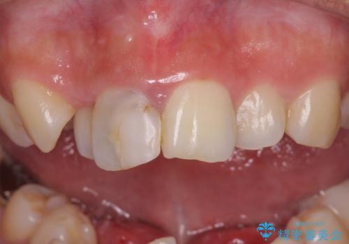 虫歯と抜いたままの奥歯とデコボコの前歯 総合歯科治療の治療前