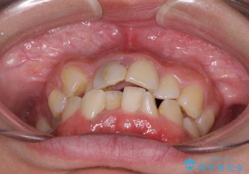 虫歯と抜いたままの奥歯とデコボコの前歯 総合歯科治療の治療前