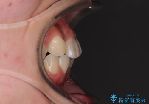 虫歯と抜いたままの奥歯とデコボコの前歯　総合歯科治療の治療前