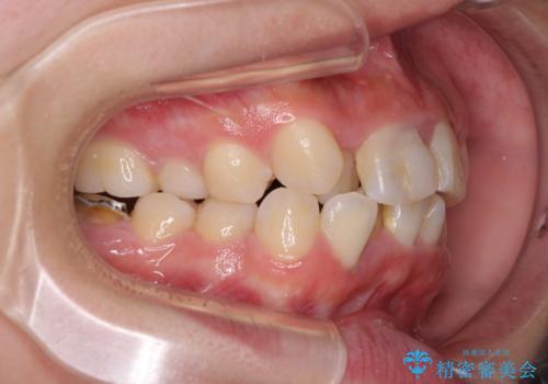虫歯と抜いたままの奥歯とデコボコの前歯 総合歯科治療の治療前