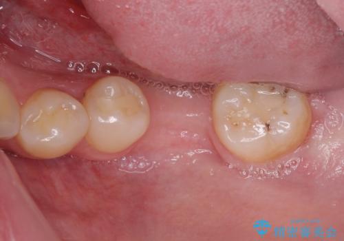 虫歯と抜いたままの奥歯とデコボコの前歯 総合歯科治療の治療前