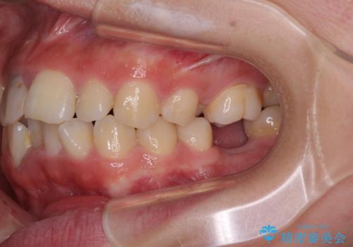 虫歯と抜いたままの奥歯とデコボコの前歯 総合歯科治療の治療前