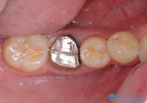 虫歯と抜いたままの奥歯とデコボコの前歯 総合歯科治療の治療前