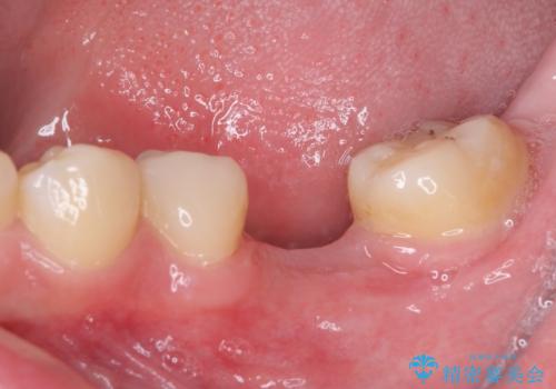 虫歯と抜いたままの奥歯とデコボコの前歯 総合歯科治療の治療前