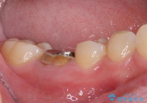 虫歯と抜いたままの奥歯とデコボコの前歯 総合歯科治療の治療前