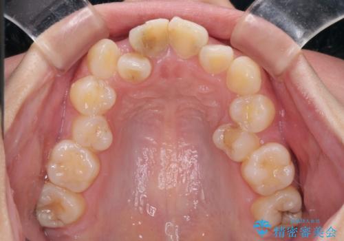 虫歯と抜いたままの奥歯とデコボコの前歯 総合歯科治療の治療前