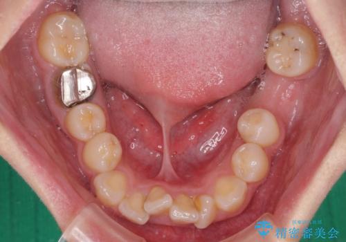 虫歯と抜いたままの奥歯とデコボコの前歯 総合歯科治療の治療前