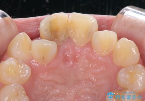 虫歯と抜いたままの奥歯とデコボコの前歯 総合歯科治療の治療前