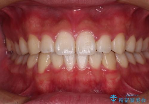 軽微叢生をインビザラインで 廉価版パッケージでの矯正治療の治療中