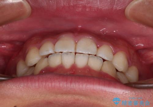 軽微叢生をインビザラインで 廉価版パッケージでの矯正治療の治療中