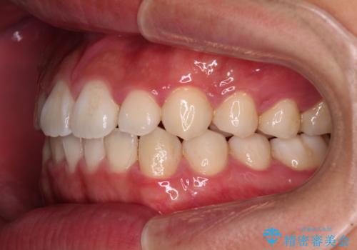 軽微叢生をインビザラインで 廉価版パッケージでの矯正治療の治療中