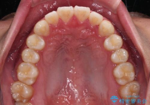 軽微叢生をインビザラインで 廉価版パッケージでの矯正治療の治療中