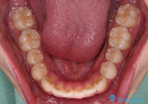 軽微叢生をインビザラインで 廉価版パッケージでの矯正治療の治療中