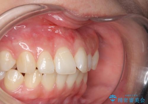 上唇小帯切除の治療後