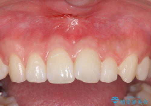 上唇小帯切除の治療後