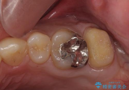 奥歯のザラザラが気になるの治療中