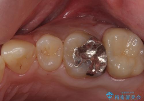 奥歯のザラザラが気になるの治療後