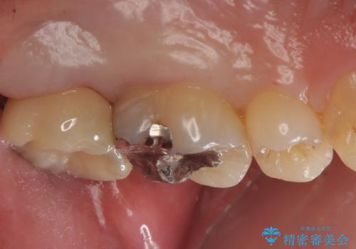 奥歯のザラザラが気になるの治療後