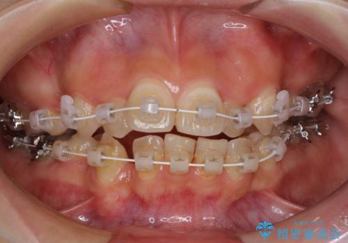 見えないほど重なっている前歯 抜歯矯正でスッキリとした歯並びにの治療中